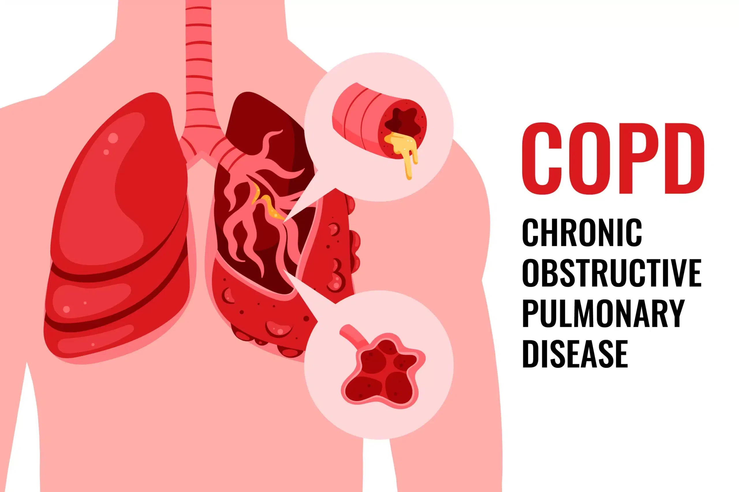 Reduce Your Risk of COPD