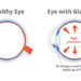 Glaucoma graphic. Healthy eye on the left. Eye with glaucoma on the right, depicting high pressure within the eye.