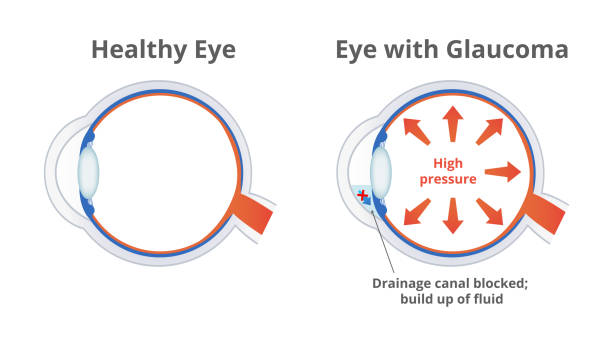 Glaucoma Prevention