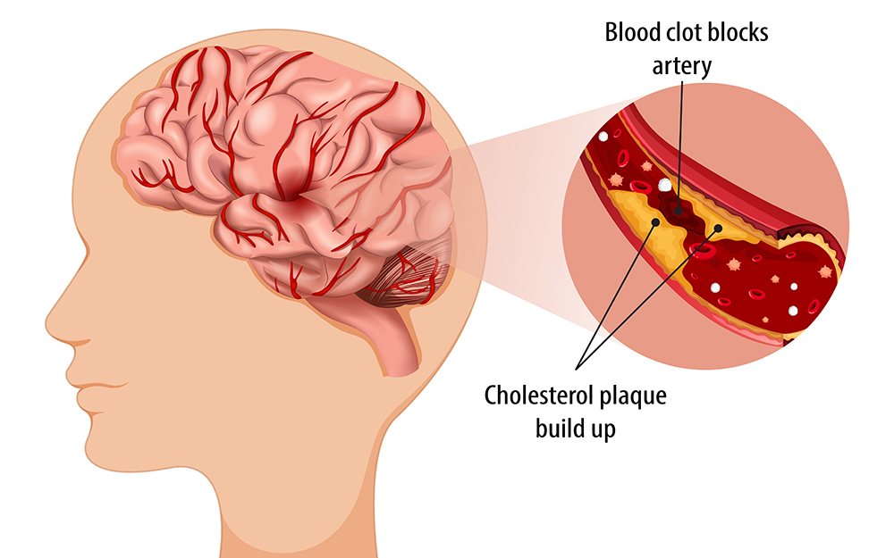 Strategies for Stroke Prevention